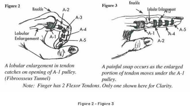 Two Diagrams of a Hand where the first is curved and the second is open