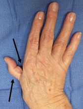 Contracture of the first web space & MP joint hyperextended