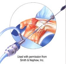 A diagram of Endoscopic Carpal Tunnel with skin and muscle removed