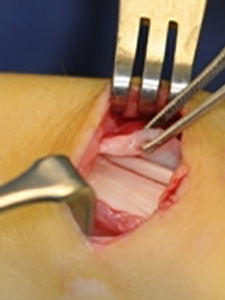 A surgical opening where the foreskin of a knee is peeled back revealing internal flesh