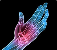 Hand of a skeleton where red indicates a specific pain area