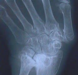 The xray image of a hand