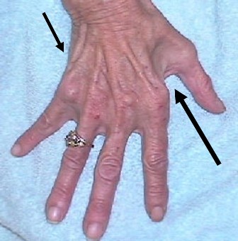 Areas of the hand with arrows to indicate Severe Wasting