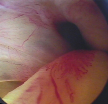 An image of Inflamed Biceps