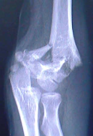 A MRI of a Supracondylar Humerus