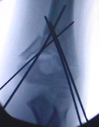 An MRI Image of a Supracondylar Humerus Fixed with metal rods inserted