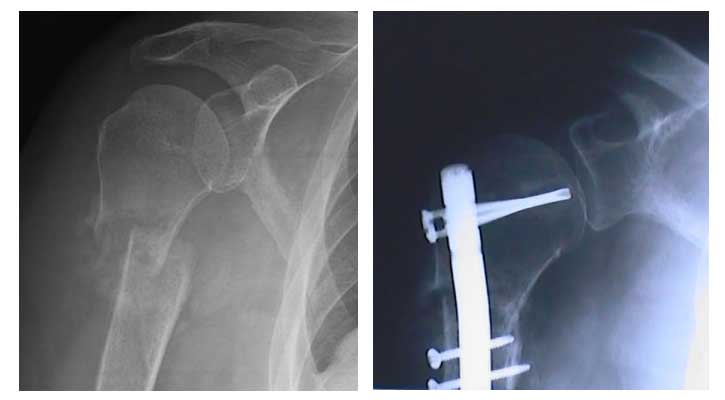 Two MRI's the first with broken shoulder and arm bones the second with a metal rod