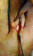 An open image of a finger where a cyst is being cut out and removed