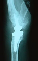 x ray post wrist arthritis surgery