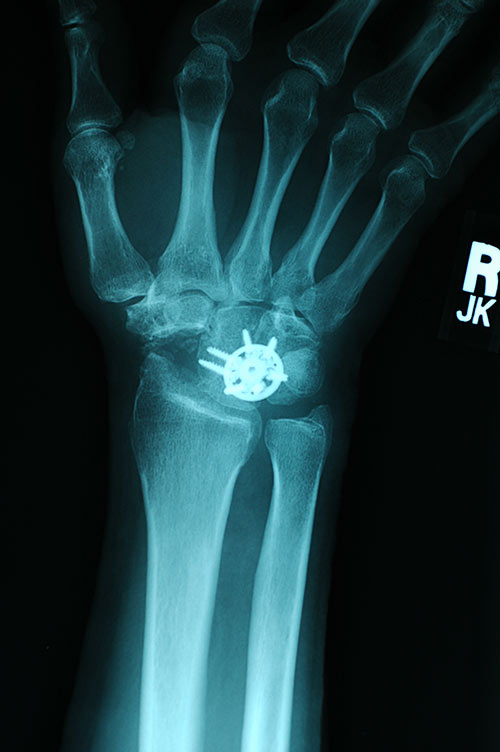x ray of limited fusion wrist