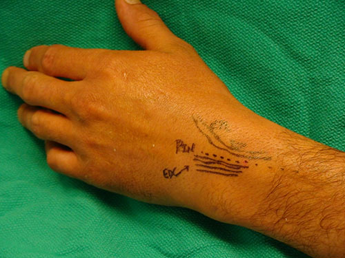 Percutaneus denervation shown on hand
