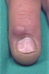 Ganglion cyst on finger below nail